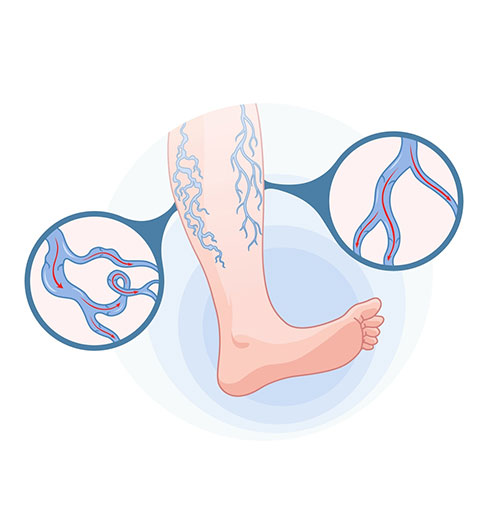 Acid Reflux Symptoms