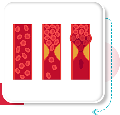 DVT blood clot treatment in Vijayawada