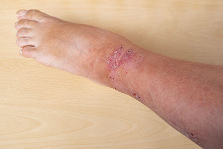 Diabetic leg ulcer treatment in Vijayawada