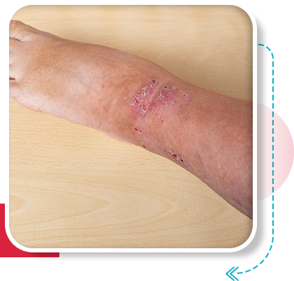 Diabetic leg ulcer treatment in Vijayawada