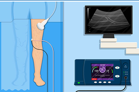 Ultrasound guided foam sclerotherapy in Vijayawada