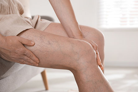 Varicose veins treatment in Vijayawada