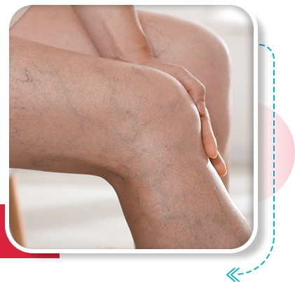 Varicose veins treatment in Vijayawada
